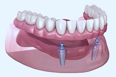 Implant-Supported Overdenture - Keys Dental Specialists